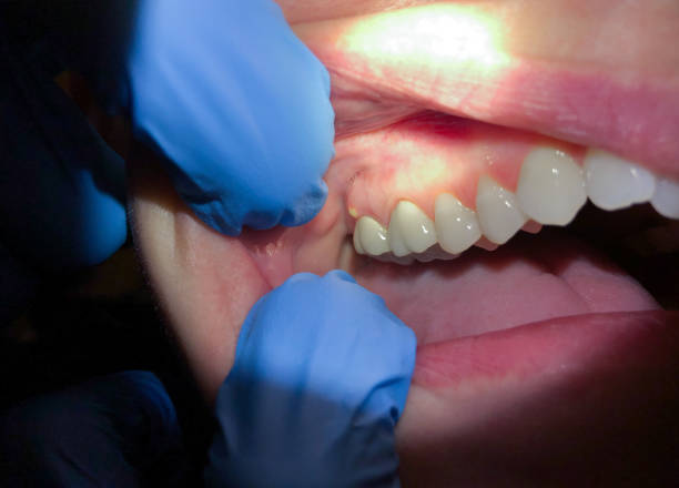 Best Emergency Root Canal Treatment in Silver Lake, NC